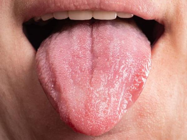 Tongue Problems